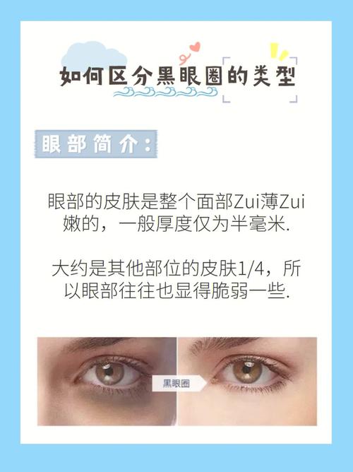 如何预防黑眼圈