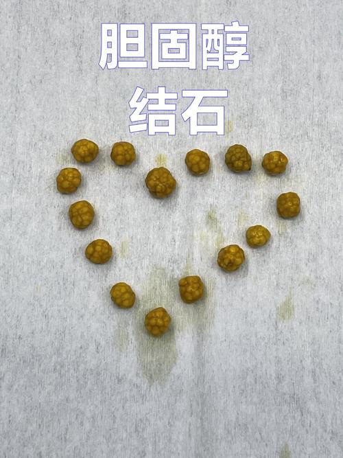 如何防止胆结石