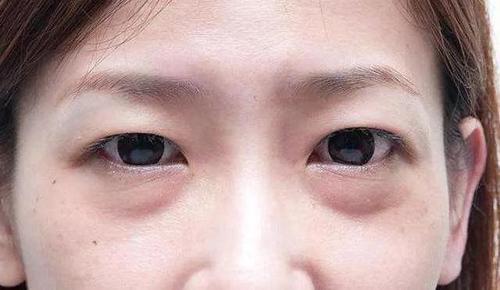 怎样预防眼袋