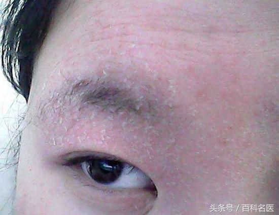 如何避免皮肤脱皮