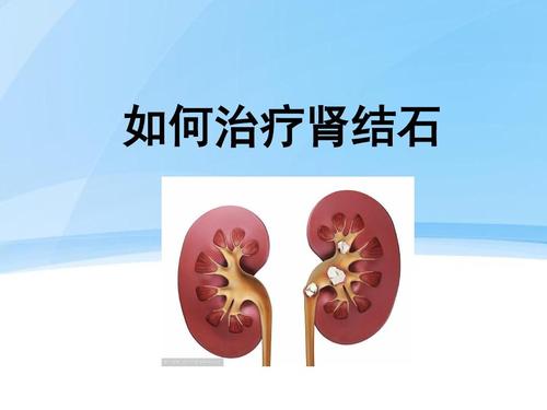 如何应对肾结石