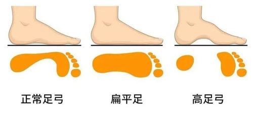 如何预防扁平足