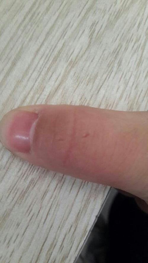 狗狗咬什么程度要打针