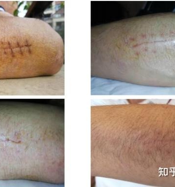 如何避免皮肤疤痕