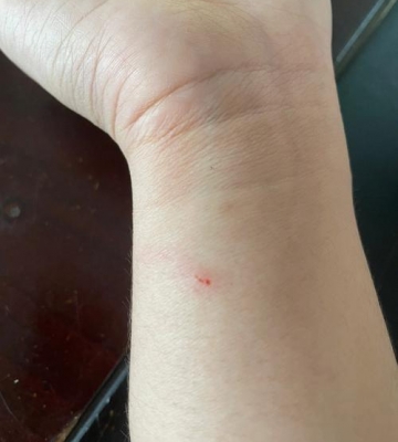 自家猫咪咬了怎么办