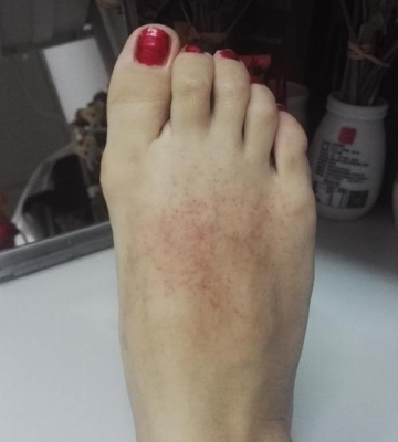 如何避免脚部过敏