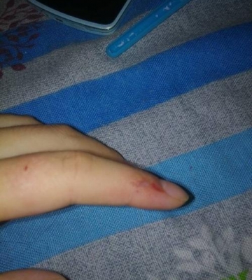 没小狗咬出血了怎么办啊