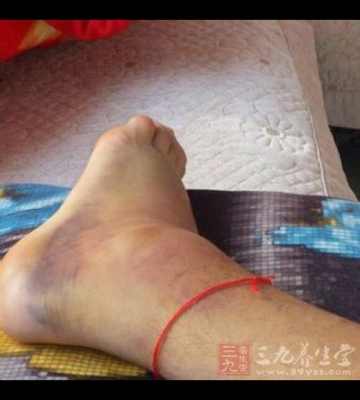 如何避免脚部肿痛