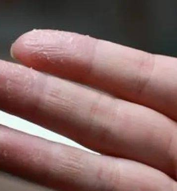如何避免手部湿疹