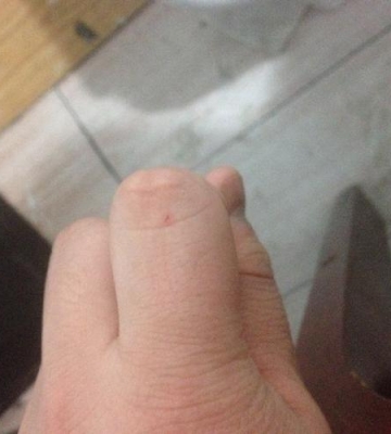 给狗狗咬了怎么办