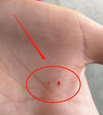小孩被被宠物鼠咬了怎么办