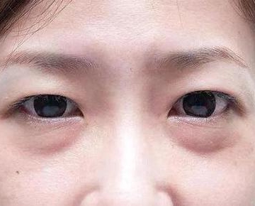怎样预防眼袋